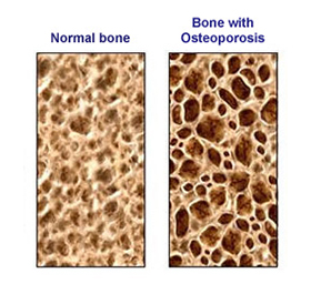cause of osteoporosis